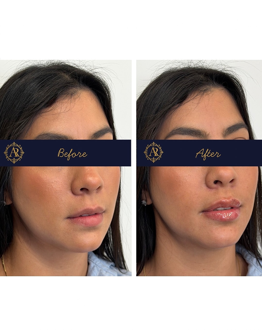 Lip Fillers  Before & After