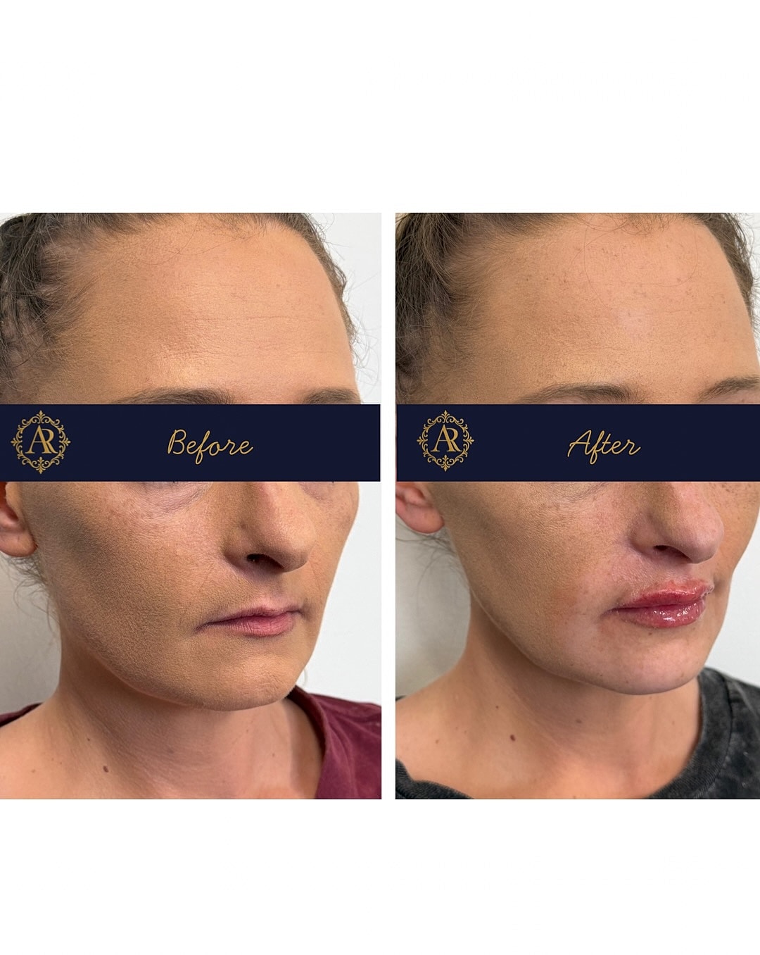 Lip Fillers  Before & After