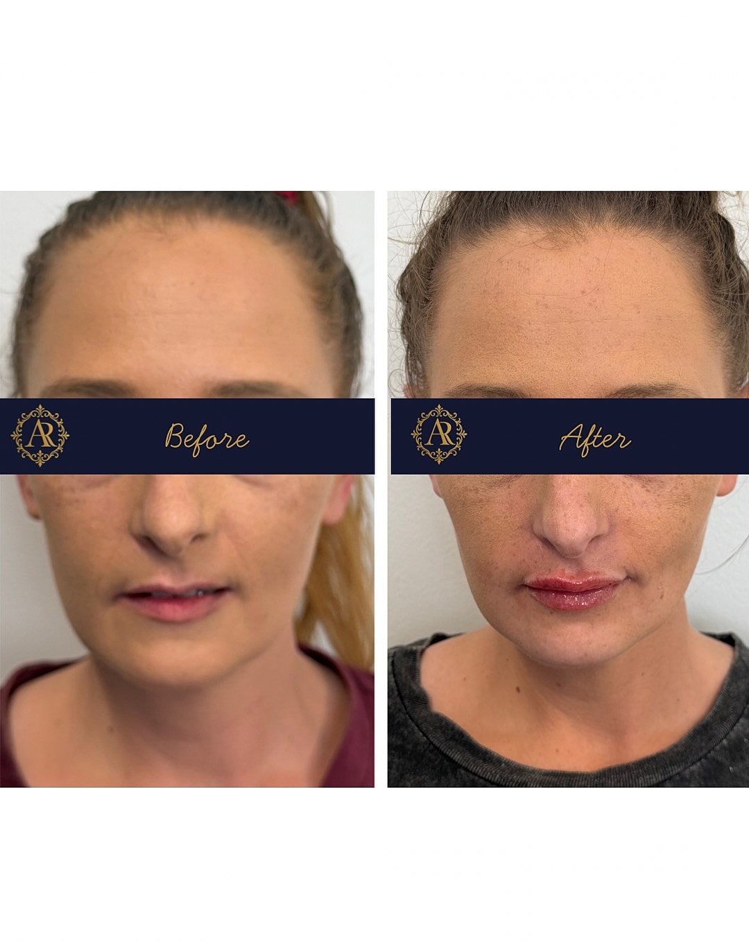 Lip Fillers  Before & After