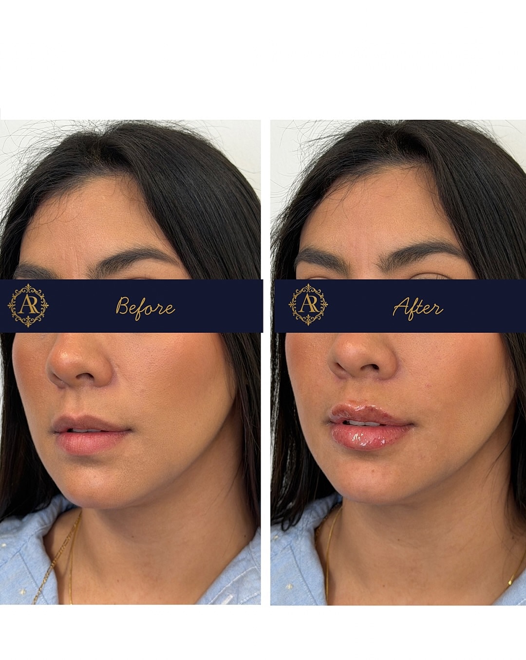 Lip Fillers  Before & After