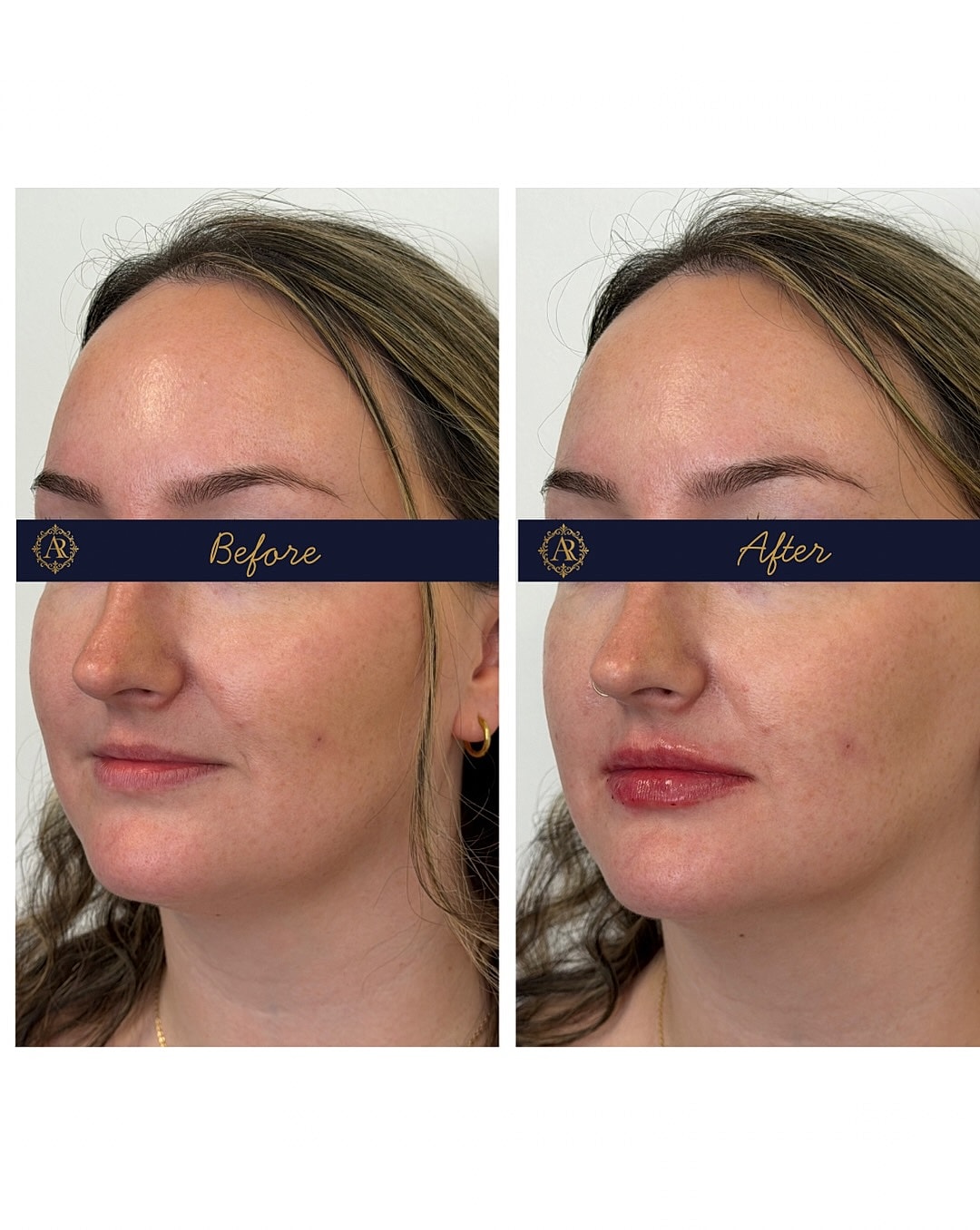 Lip Fillers  Before & After