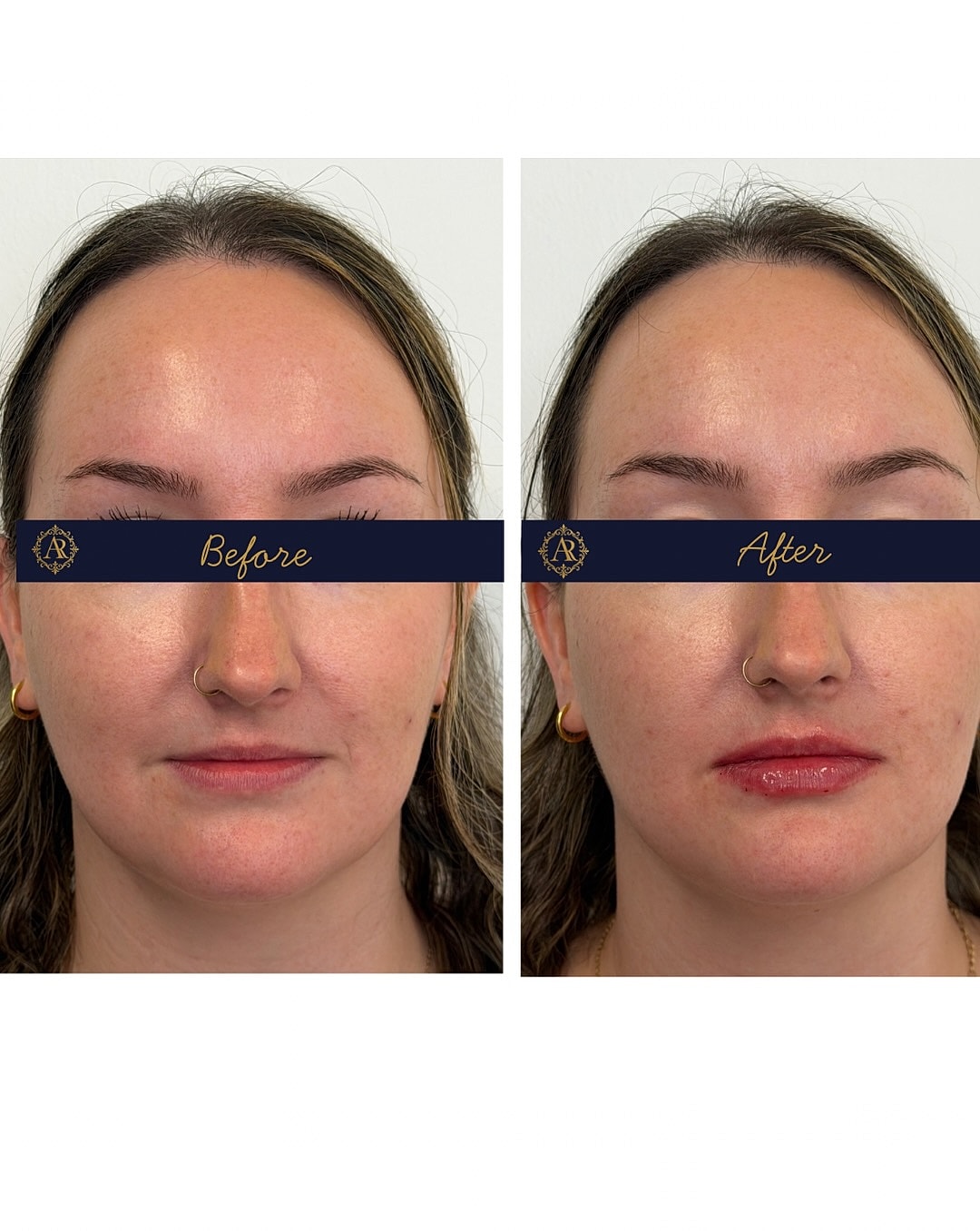 Lip Fillers  Before & After