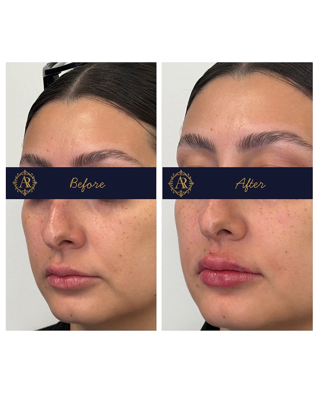 Lip Fillers  Before & After