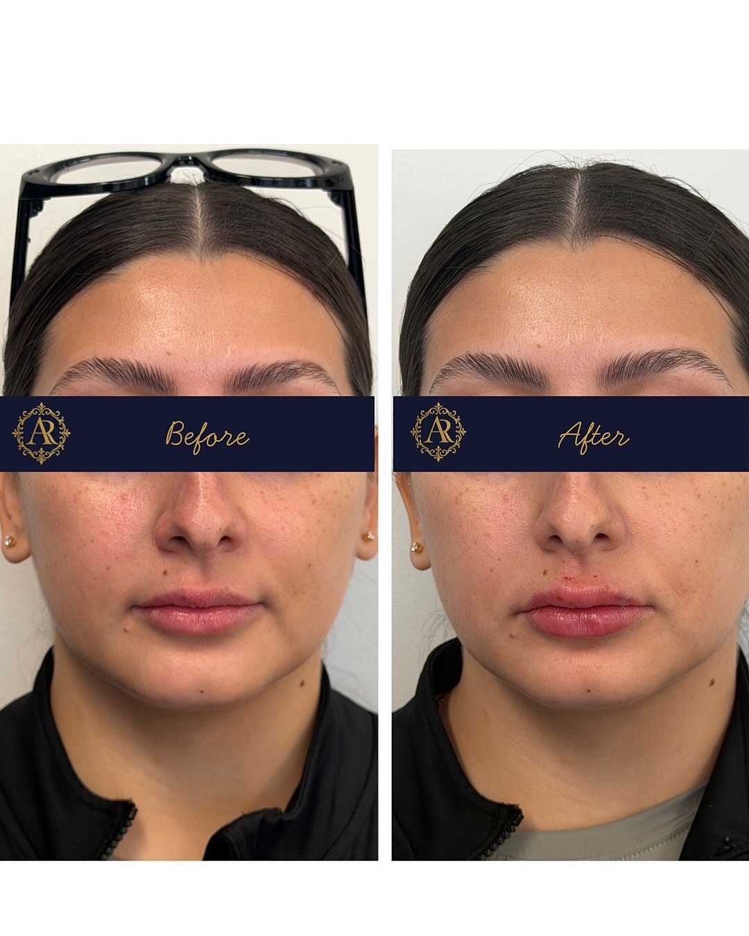 Lip Fillers  Before & After