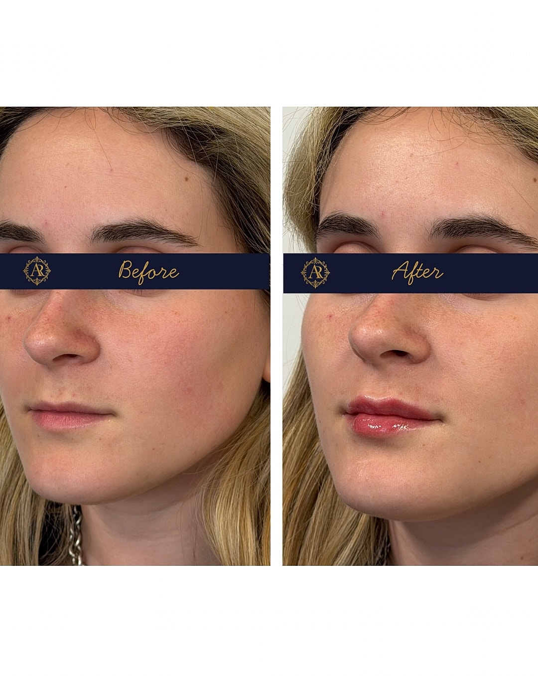 Lip Fillers  Before & After