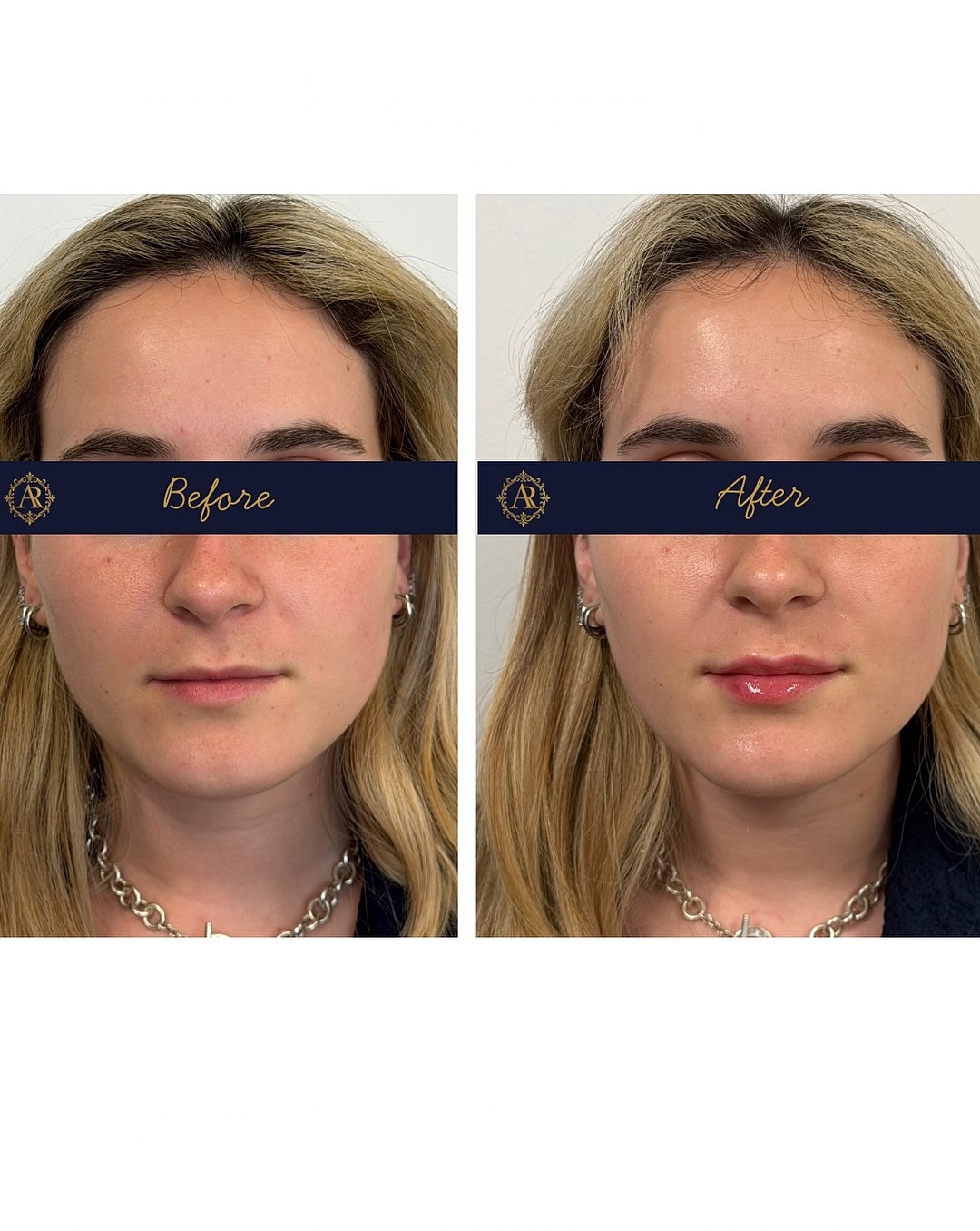 Lip Fillers  Before & After