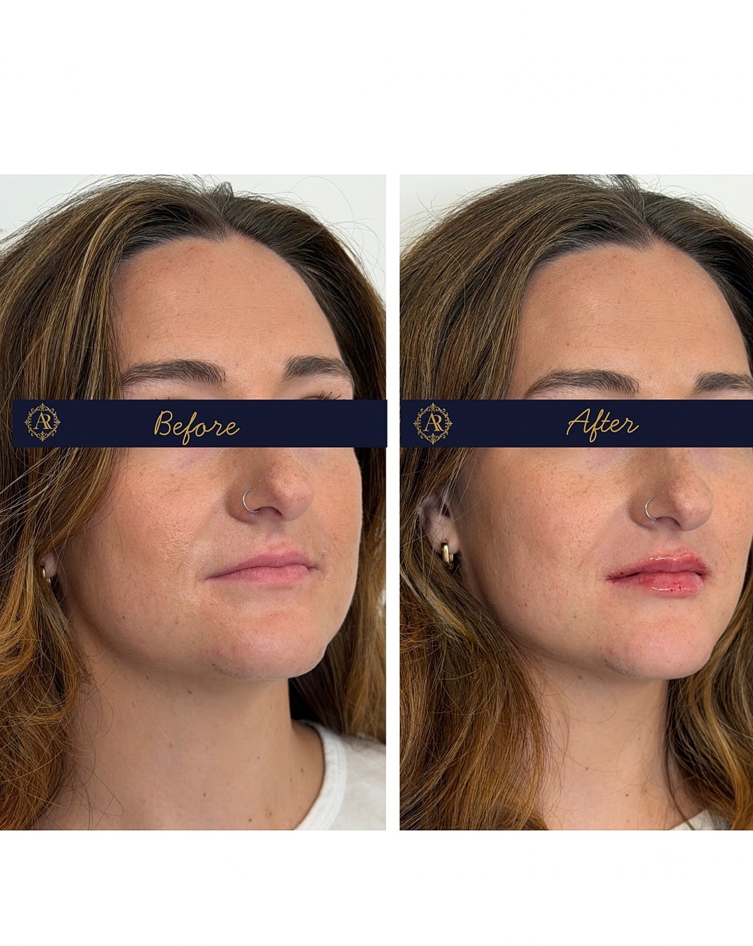 Lip Fillers  Before & After