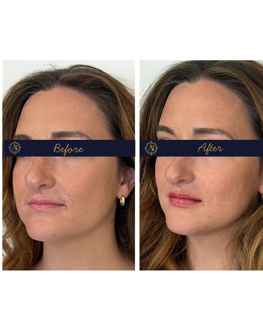 Lip Fillers  Before & After