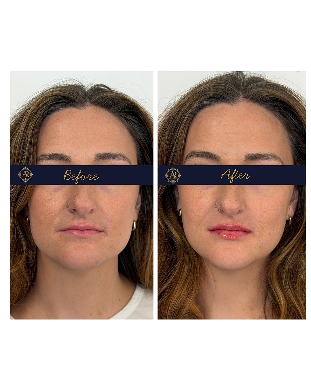 Lip Fillers  Before & After